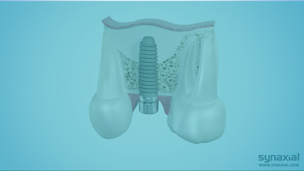 SinusJet® Crestal Sinus Lift Kit